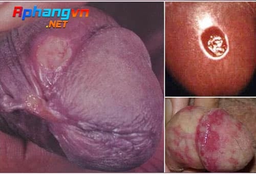 5c6f649a6c143bae762af899_hinh-anh-benh-giang-mai-o-nam-gioi.jpg