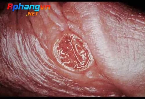 5c6f648e89c36838d172a98f_hinh-anh-benh-giang-mai-o-nam.jpg