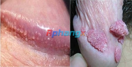 hinh-anh-sui-mao-ga-o-ranh-bao-quy-dau.jpg