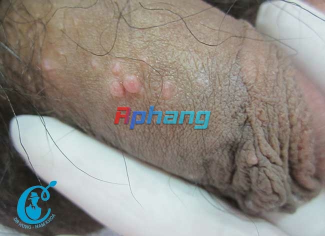 benh-u-mem-lay-o-duong-vat.jpg